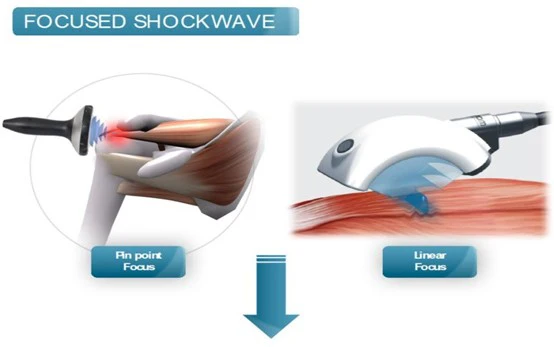 Chiropractic Watauga TX Focused Shockwave Chiropractic Watauga TX Focused Shockwave