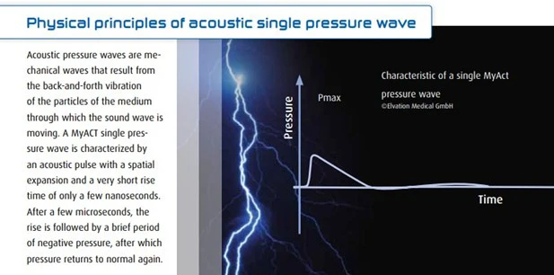 Chiropractic Watauga TX Shockwave Pressure Wave Chiropractic Watauga TX Shockwave Pressure Wave